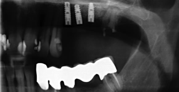 Freiendsituation im linken Oberkiefer - Versorgung mit 3 Implantaten