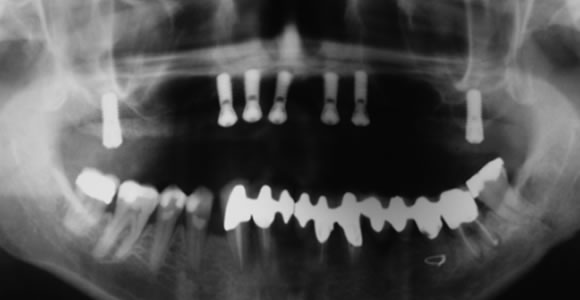 Zahnloser Oberkiefer mit 7 Implantaten versorgt und einer abnehmbaren Brücke