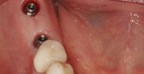 Freiendsituation rechter Unterkiefer - Ansicht der 2 Implantate im Mund