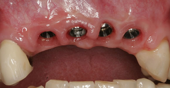 Ansicht der Zahnimplantate