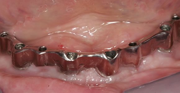 Zahnloser Unterkiefer mit 4 Implantaten und individuellem Goldsteg