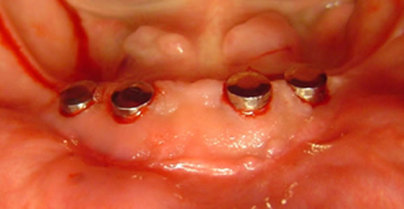 Ansicht der 4 Implantate und Magneten im Mund