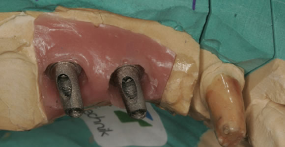 Verbundbrücke - 2 Implantate werden mit einem Zahn verbunden (Hybridbrücke)